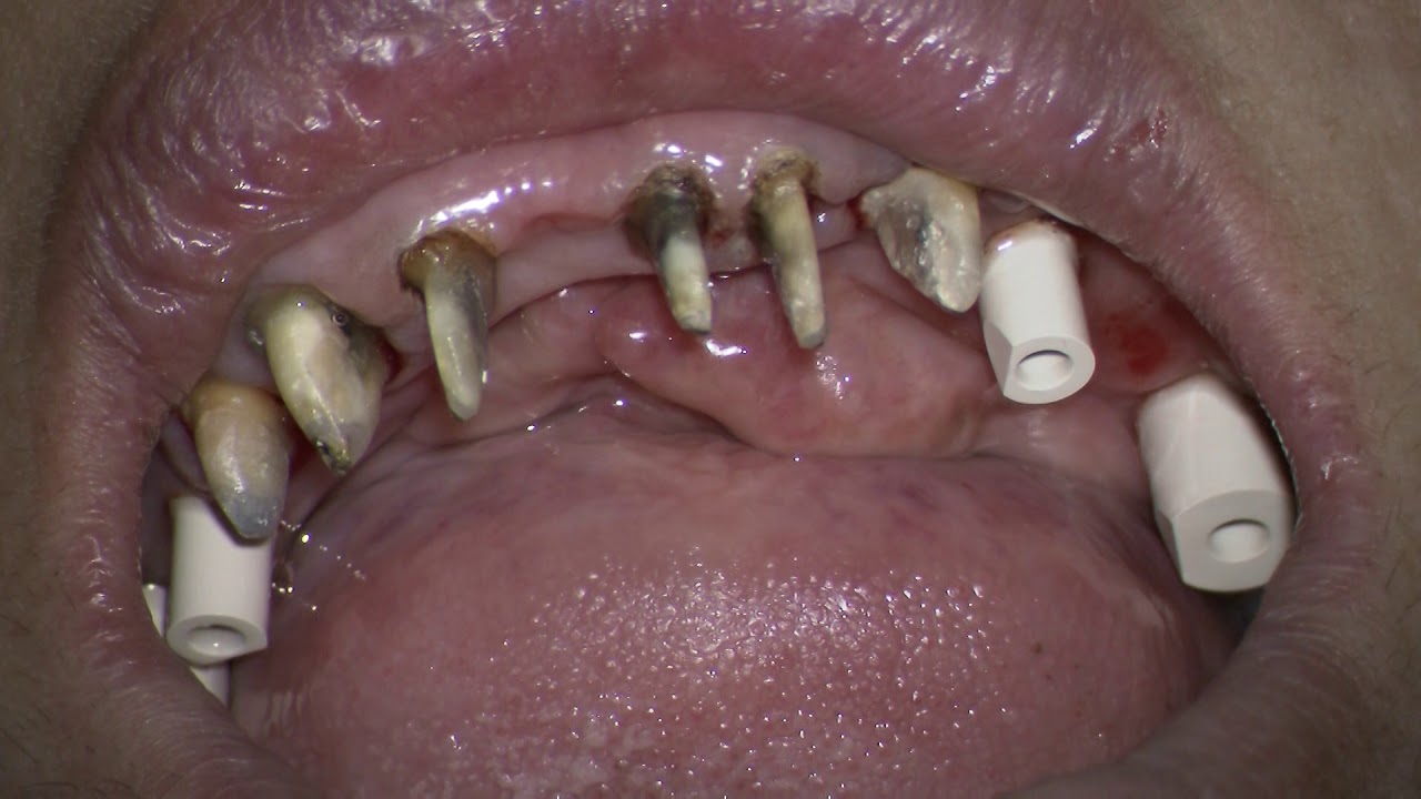 3 Shape Scanner Digital Impression Of Teeth And Straumann Implants In 