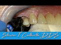 Class Five (Gingival Facial) Composite - Dental Minute with Steven T. Cutbirth, DDS