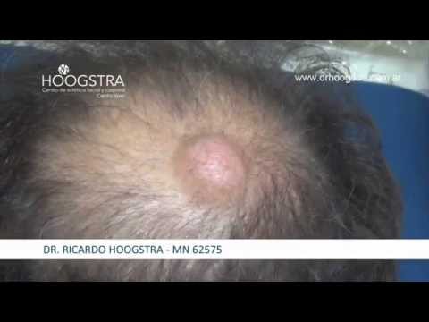 El hongo de las uñas y el sistema nervioso