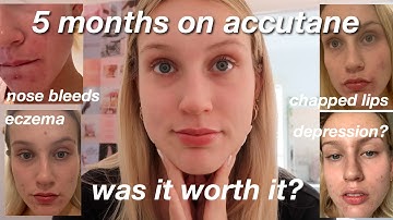 my accutane skin journey | ALL the side effects | Was it worth it?