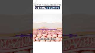 실리프팅 부작용 딤플현상 해결방법 #실리프팅 #실리프팅부작용