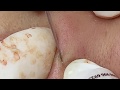 Acne Treatment Hidden Under The Skin | Điều Trị Mụn Ẩn Dưới Da - SacDepSpa#195