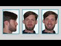 Less appointments with the Carriere System - Alternative to Jaw surgery | Henry Schein Orthodontics
