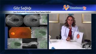 Sarı Noktadaki Hastalıklar Nasıl Tedavi Edilir?