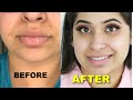 Get Baby Soft Pink Lips in just 1 Day Naturally at Home (Easy &amp; 100% Works) | DIY WEEK2 | DAY4