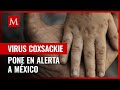 Qué es el coxsackie y cómo se contagia la enfermedad que tiene en alerta a México