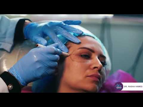 الخيوط الفرنسية وإستخدامتها مع دكتور رشا حامد إستشاري الجلدية والتجميل والليزر