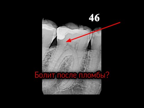 Боли После Постановки Пломбы  Разбор Консультации