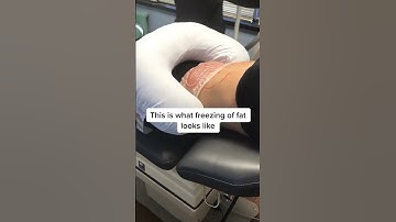 How we freeze fat with CoolSculpting #shorts