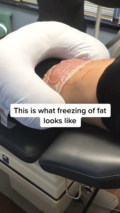 How we freeze fat with CoolSculpting #shorts