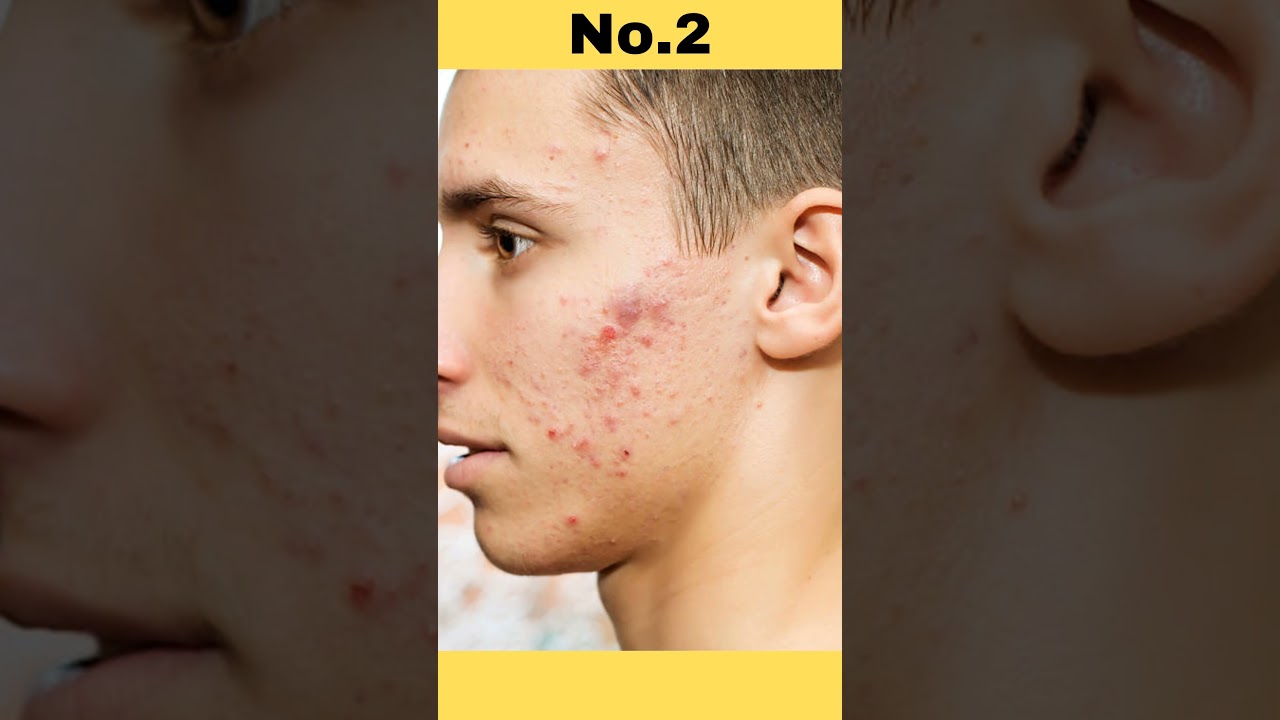 3 Pimple Mistakes in Summer Season. #xarry #shorts