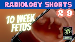 Radiologyshorts 29 10Week Fetal Ultrasound Nobakbak Videos