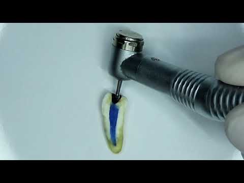 Video: ¿Cómo hacer una pulpotomía en un diente permanente?