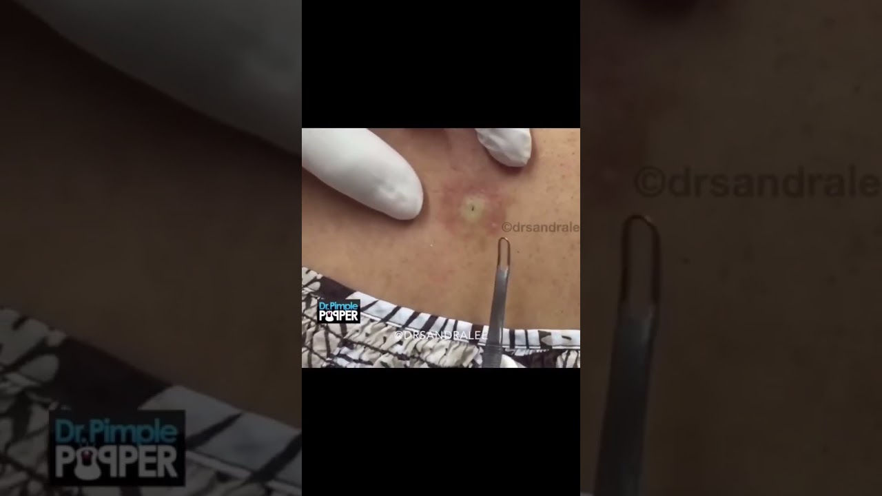 The gift that kept on giving! A Non-Stop Pop by Dr Pimple Popper ✌️❤️💥