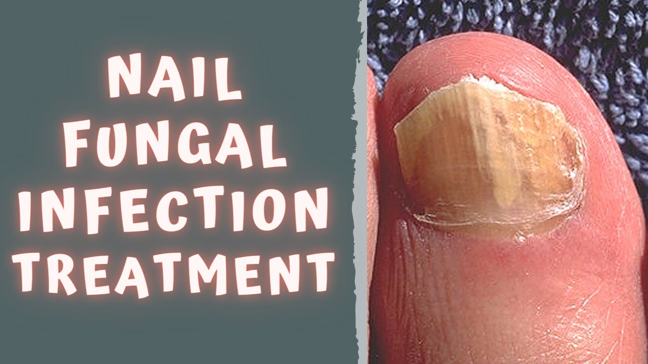 Why Is Toenail Fungus So Difficult to Treat? | University Hospitals
