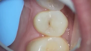 Is a black spot on tooth a cavity?