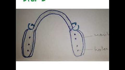 Altered Cast Technique in Removable partial Dentures