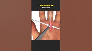 Trigger Finger Release Surgery (3D Animation) #triggerfinger #triggerfingerrelease #triggerfinger?