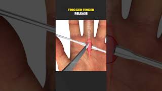 Trigger Finger Release Surgery (3D Animation) #triggerfinger #triggerfingerrelease #triggerfinger?