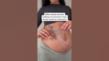 Thumbnail of Clinically proven stretch mark treatment ❤️