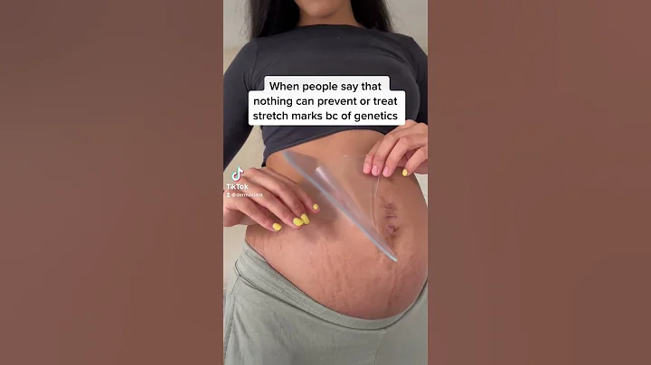 Clinically proven stretch mark treatment ❤️ - DayDayNews