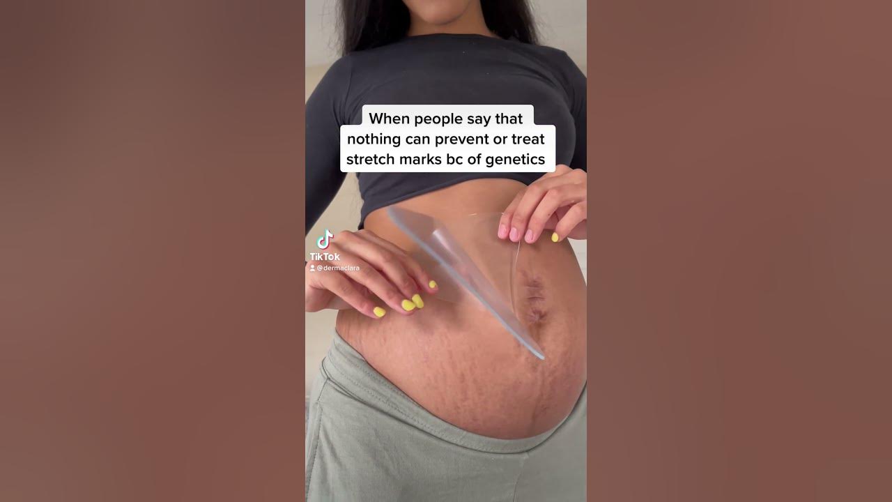 Clinically proven stretch mark treatment ❤️