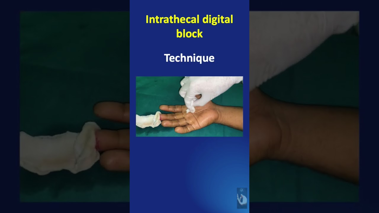 Digital Nerve Block Technique: Approach Considerations, Web-Space Block,  Transthecal Block