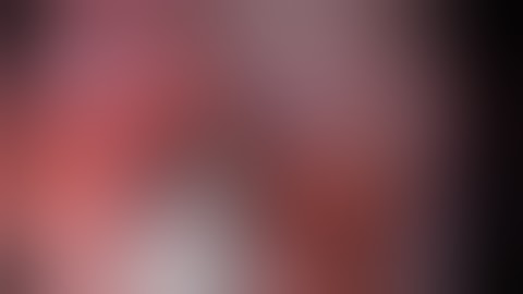 uniportal VATS right apical (RS1) segmentectomy (unedited)