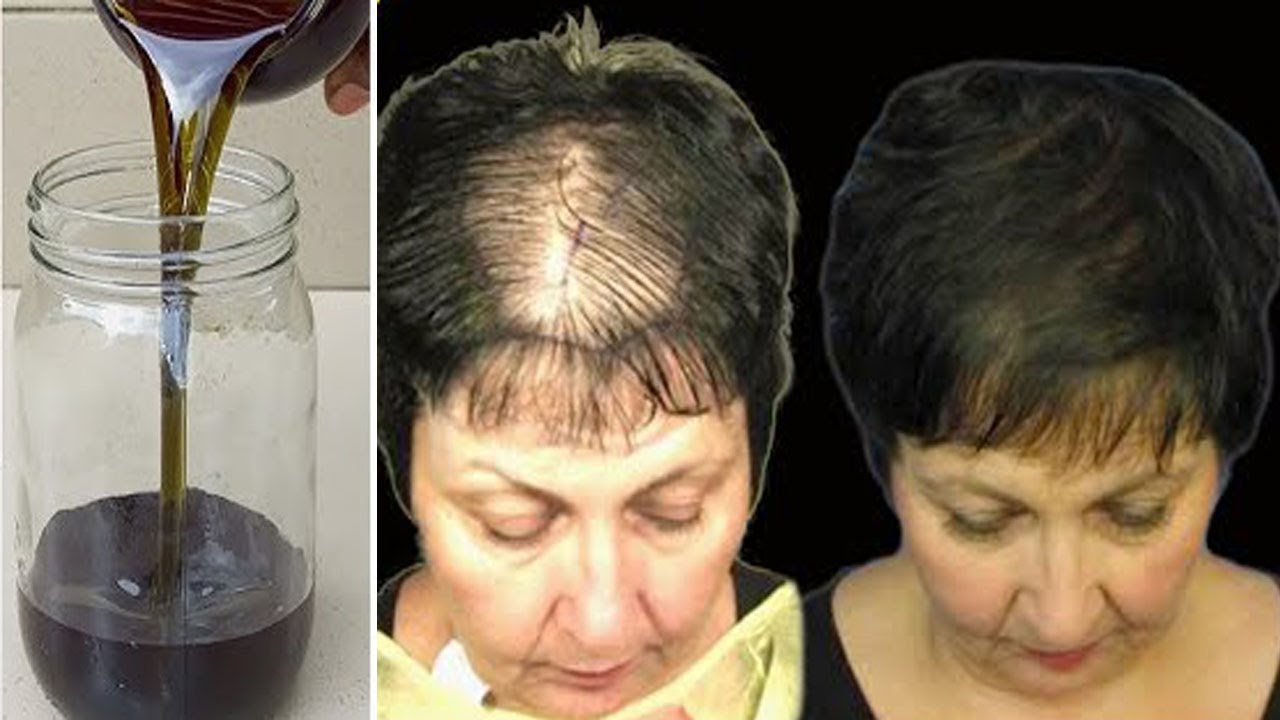 With Just 2 Powerful Ingredients and Your Hair Will Grow Super Fast! Hair Growth Recipe!