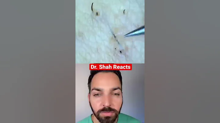 Doctor Reacts to Ingrown Hair #shorts - DayDayNews