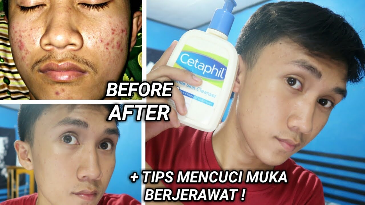  SABUN  UNTUK  KULIT BERJERAWAT TIPS MENCUCI MUKA 