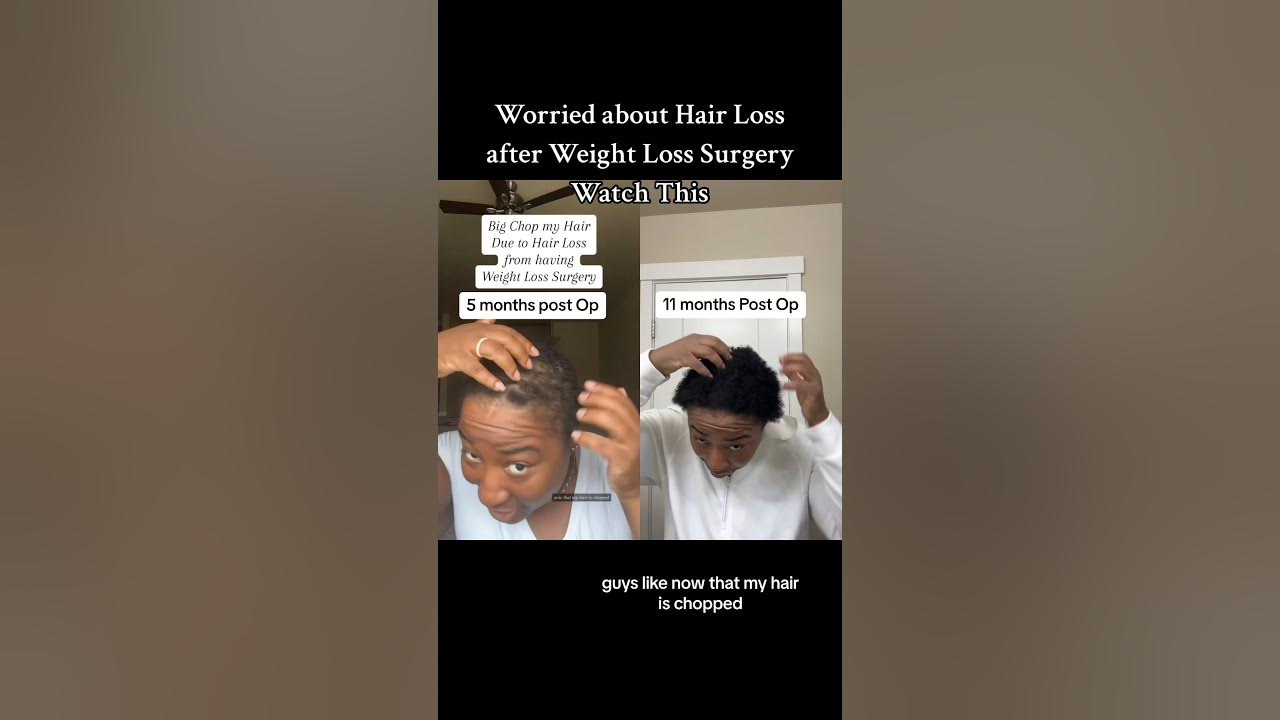 hair-regrowth-after-weight-loss-surgery-weightloss-wlsjourney