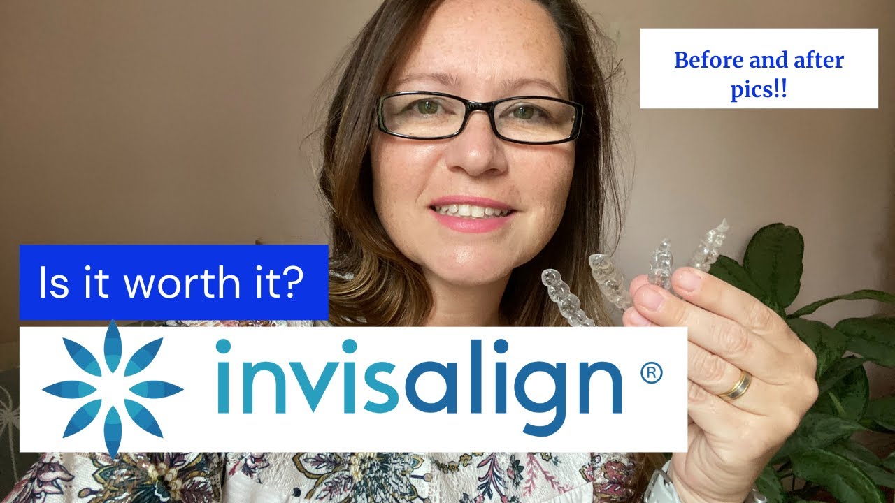 INVISALIGN REVIEW My Invisalign Journey/Pain, Cost, Was it really