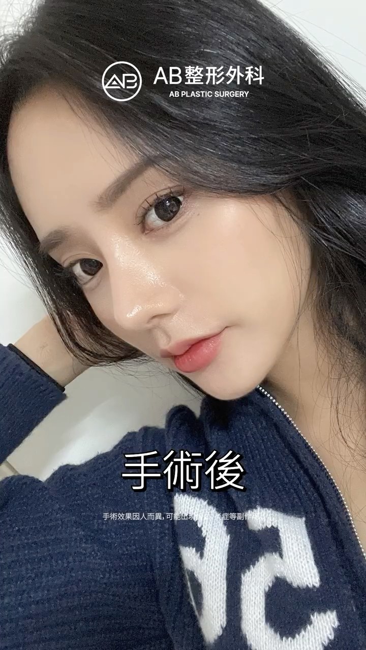 原來隆鼻的變化這麼大？#Shorts
