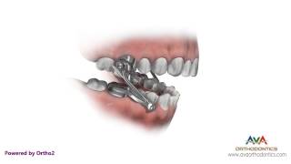 Orthodontics Treatment for Overjet (Overbite) - Herbst Appliance
