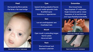 Down Syndrome: Dysmorphic Features
