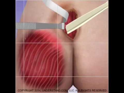 Queria ver um filme de pornô Cirurgia de silicone na bunda