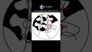 L4/5, 5/S1 facet joint block #방사선사 #씨암 #carm #신기술씨암