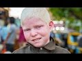 25 Facts About Albinism We Might Want To Be Aware Of