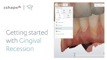 How to detect Gingival Recession with Dx Plus