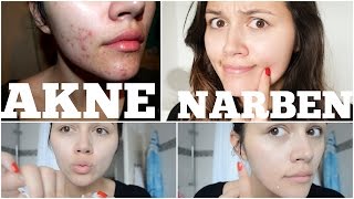 Akne Narben Schnell Entfernen Tipps Betterskinwithanna Youtube