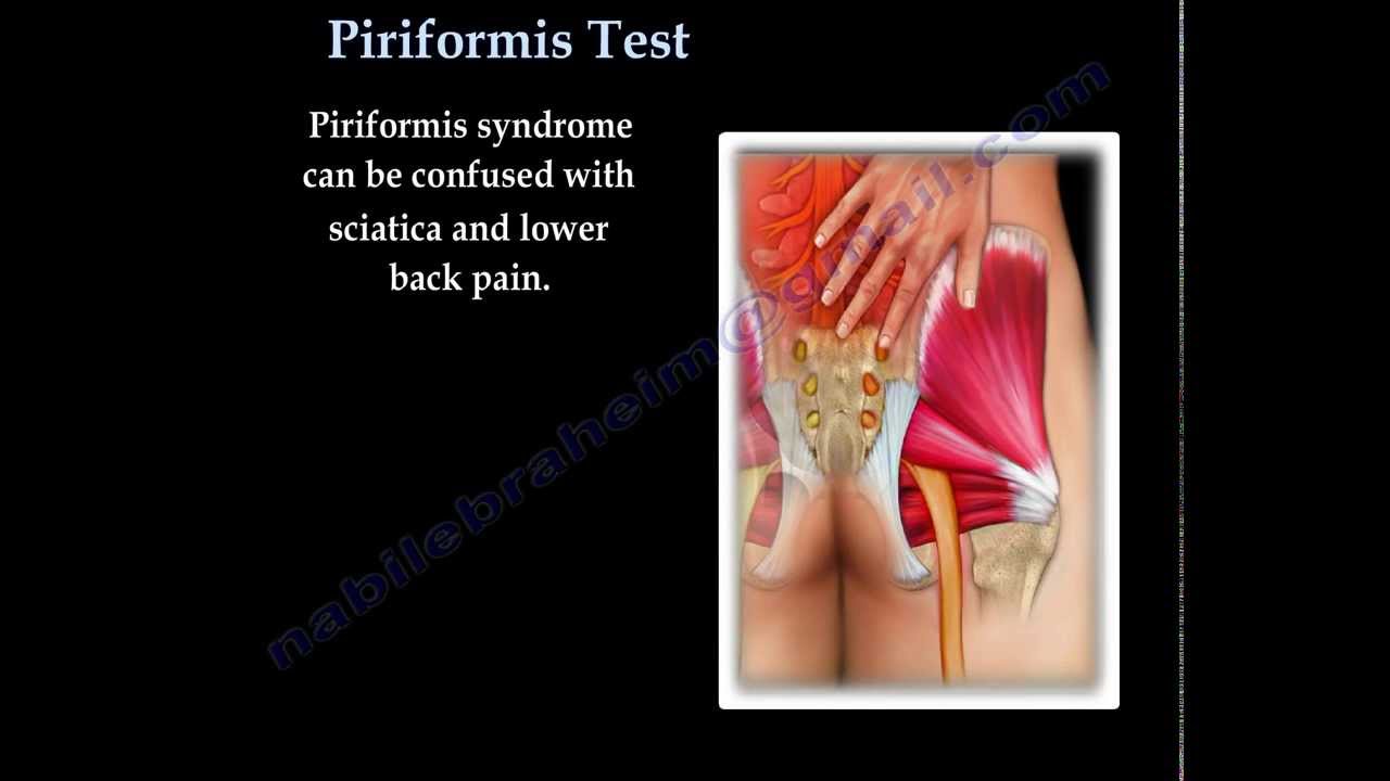 Piriformis syndrome Is Piriformis