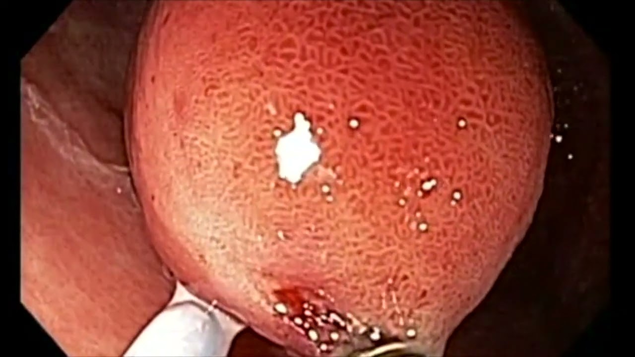Endoscopic resection of a gastric GI stromal tumor using the helix-snaring technique