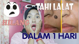 Download lagu CARA MENGHILANGKAN TAHI LALAT DALAM 1 HARI 100 work how to remove skin tag SONIASHSP CARA MENGHILANGKAN TAHI LALAT DALAM 1 HARI 100 work how to remove skin tag SONIASHSP