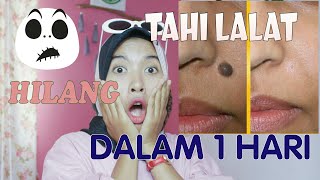 CARA MENGHILANGKAN TAHI LALAT DALAM 1 HARI 100% work | how to remove skin tag | SONIASHSP