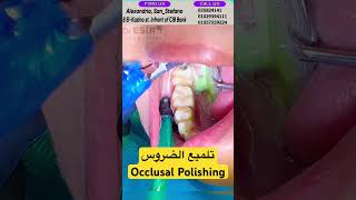 تسوس الاسنان | تلميع الضروس Dental Polishing viral لايك دكتور_اسلام_نبيل
