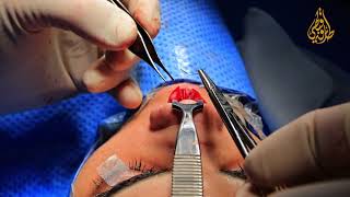 تصحيح أرنبة الأنف بطريقة د. طارق قبطي | Rhinoplasty technique with Dr. Tariq Copty