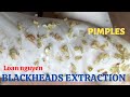 Best blackhead extraction on the face 155  loan nguyen