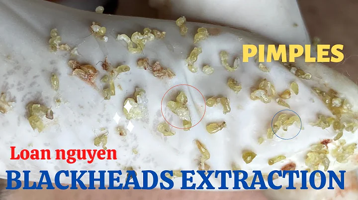 Best blackhead extraction on the face (155) | Loan...