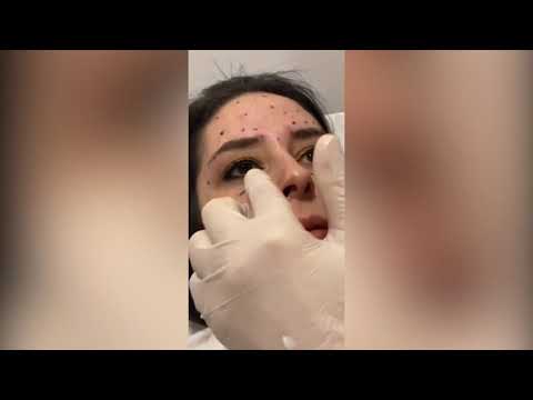 Video: ¿Se puede hacer un estiramiento facial sin cirugía?